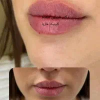 لیزرمو زائدبدن،تزریق ژل،بوتاکس،پاک کردن تتوبالیزر