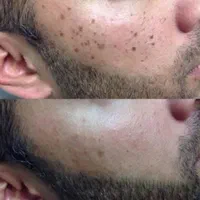 رفع انواع خال کک مک لک بادستگاه پیشرفته