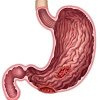 معده گوارش یبوست اسهال