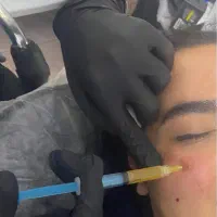مدل فیلر و بوتاکس رایگان