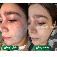 خدمات حرفه ای تخصصی،لک کک مک موی زائدسفیدالکترولیز|خدمات آرایشگری و زیبایی|قم, صفائیه|دیوار