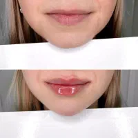 بوتاکس ژل نخ بلفاروپلاستی مزو چربی|خدمات آرایشگری و زیبایی|اصفهان, مولوی|دیوار