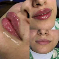 تخفیف استثنایی خدمات ژل فیلر بوتاکس