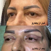 بلفارو پلاستی پلک بالا و پایین در کلینیک مهرزاد