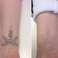 مرکز تخصصی لیزر تتو