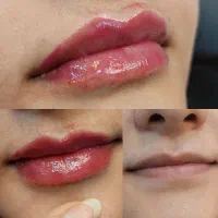آموزش و تزریق ژل و بوتاکس ومزو|خدمات آموزشی|شیراز, تندگویان|دیوار