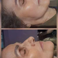 مرکز لیفت لاغری هایفو سنندج (فیلرژل)