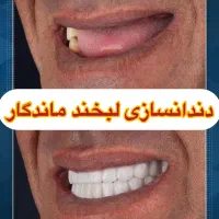 دندانسازی  ( دندان مصنوعی ) دندان متحرک