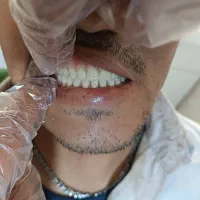 دندان مصنوعی|خدمات آرایشگری و زیبایی|مشهد, عبادی|دیوار