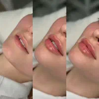 تزریق ژل و بوتاکس|خدمات آرایشگری و زیبایی|دوگنبدان, |دیوار