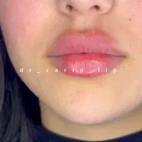تزریق تخصصی فیلر زیر چشم بینی ژل لب روسی لیفت گونه|خدمات آرایشگری و زیبایی|تهران, پونک|دیوار