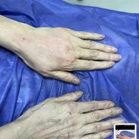 تزریق چربی جهت زیبائی دست و صورت
