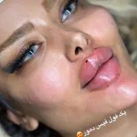 تزریق ژل وفیلر