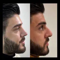 بمب تخفیف عمل بینی ۵۰درصد واقعی|خدمات زیبایی و سلامت|تهران, نظامی گنجوی (توانیر)|دیوار