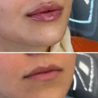 ژل،بوتاکس،لیزرخال و تاتو
