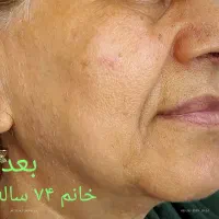 لیفت وجوانسازی قوی صورت|خدمات آرایشگری و زیبایی|رشت, گلسار|دیوار