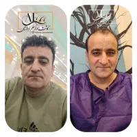 کاشت مو فول تراکم طبیعی و تضمینی