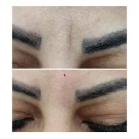 لیزر هایفو ژل بوتاکس ریمو تتو|خدمات آرایشگری و زیبایی|بوشهر, |دیوار