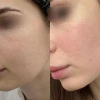 کرم سفید کننده وضدلک|آرایشی، بهداشتی، درمانی|اهواز, کمپلو جنوبی|دیوار