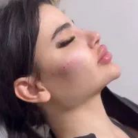 4 سی سی تزریق فیلر یک سی سی فیلر رایگان|خدمات آرایشگری و زیبایی|تهران, نیروی هوایی (پیروزی)|دیوار