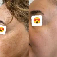 کرم ضدلک تخصصی بیوممتیک