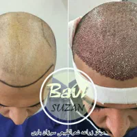 کاشت مو طبیعی سر و ابرو و ریش با ضمانت نامه کتبی|خدمات آرایشگری و زیبایی|اهواز, کیانپارس |دیوار