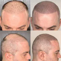 خداحافظی با کم‌پشتی مو.اسکالپ تخصصی