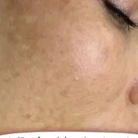 درمان لک درخانه|آرایشی، بهداشتی، درمانی|زرند, |دیوار