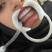 کامپوزیت دندان هر فک 5تومن