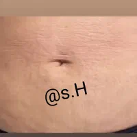 لیزرمیکرو پلاسمالیفت زیبایی/ بینی شیک/بلفاروپلاستی|خدمات آرایشگری و زیبایی|کرمانشاه, |دیوار