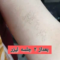 لیزر تاتو و خالکوبی و جوانسازی پوست(کر۰بنتراپی)|خدمات آرایشگری و زیبایی|محمدشهر, |دیوار