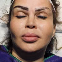 کاشت مو سر و  ابرو کاملا طبیعی و مادام العمر