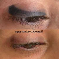 ریموو تخصصی تتوی ابرو، چشم، لب