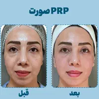 خال برداری، پی آر پی ،پرسینگ بوتاکس|خدمات آرایشگری و زیبایی|مشهد, موسوی قوچانی|دیوار