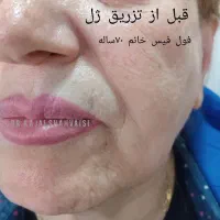 مطب زیبایی دکتر کژال شاه ویسی تزریق ژل بوتاکس..|خدمات آرایشگری و زیبایی|سنندج, |دیوار