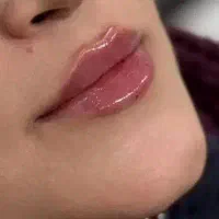 آموزش‌تزریق ژل‌لب/بوتاکس/طب سوزنی/امبدینگ