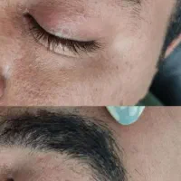 برداشتن خال و زگیل و منگوله های پوستی