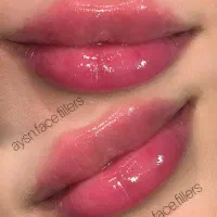 تزریق ژل بوتاکس فیلر با تخفیف|خدمات آرایشگری و زیبایی|گنبد کاووس, |دیوار