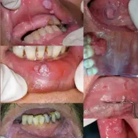 رفع دائمی زگیل و تبخال تناسلی|آرایشی، بهداشتی، درمانی|شیراز, شهرک گلها|دیوار