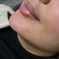 تزریق فیلر توسط پزشک برند رووفیل ۶۹۸ تومان|خدمات آرایشگری و زیبایی|خرم‌آباد, |دیوار