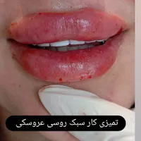فیلر لب.بوتاکس.مزوژل.لب روسی.|خدمات آرایشگری و زیبایی|بندر انزلی, چهارفریضه|دیوار