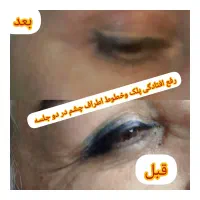 برداشتن خالهای گوشتی و سطحی|خدمات آرایشگری و زیبایی|کرج, عظیمیه|دیوار