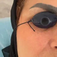 اف یلدا ریمو (پاک کردن تتو) ابرو در کلینیک زیبایی