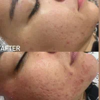 مرکز مشاوره و خدمات پوستی پاکسازی و فیشیال|آرایشی، بهداشتی، درمانی|قم, زنبیل آباد|دیوار