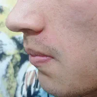 برداشتن زگیل تناسلی برای آقایان و خانم هادریکجلسه|خدمات آرایشگری و زیبایی|کرج, گلشهر|دیوار