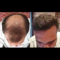 کاشت مو فقط ۱۳ تومان (نقد و اقساط) بدون جراحی