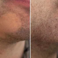 احیای کامل ریزش سکه ای و غیره سر و صورتتون