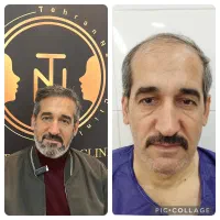 کاشت مو و ابرو با ضمانتنامه کتبی با ۸ ملیون تومان|خدمات آرایشگری و زیبایی|تهران, پاسداران|دیوار