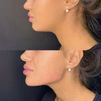 ساکشن فوق تخصصی غبغب توسط پزشک