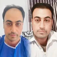 کاشت موی شیرازی جدیدترین متدد شرایط ویژه فقط ۲۴۹۰۰